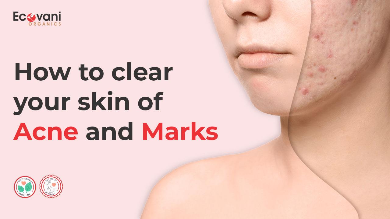 How to clear your skin of acne and marks